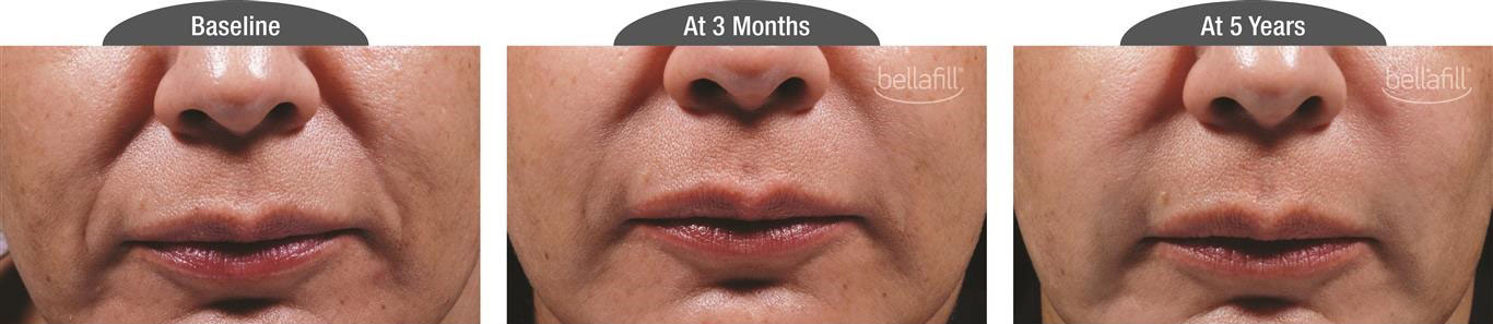 Bellafill patient before and after 5 years.