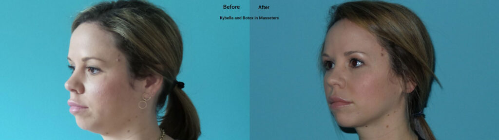 kybella botox raleigh before after
