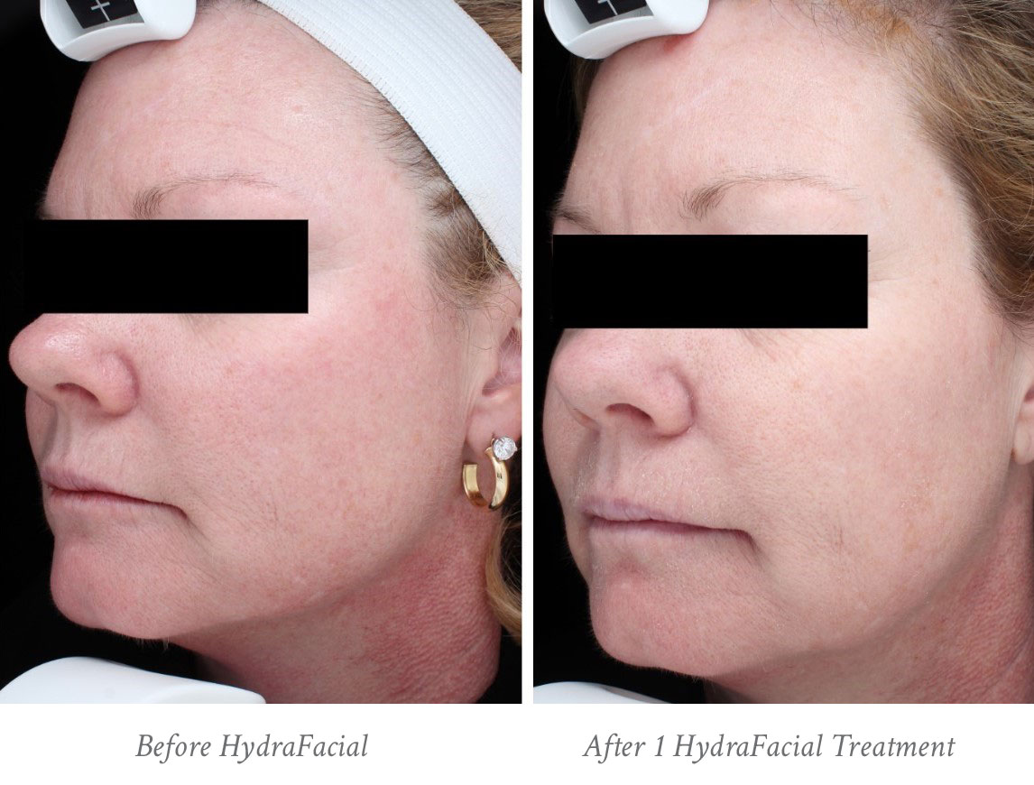raleigh hydrafacial before after slutsky raleigh hydrafacial before after slutsky