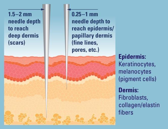 mcironeedling depth pic