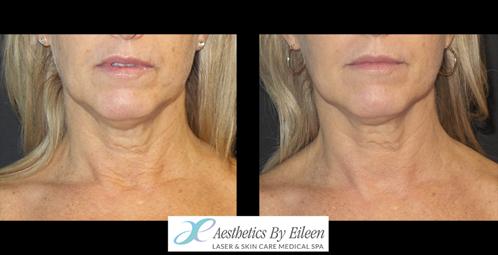 fraxel neck fraxel neck