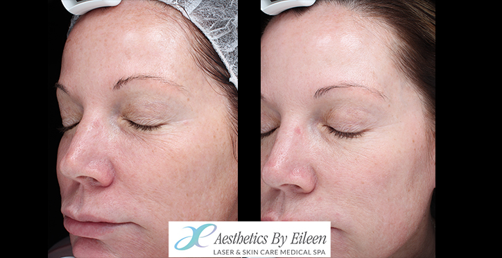 microneedling Rengifo