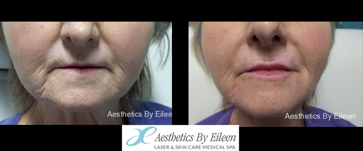 restylane refyne defyne