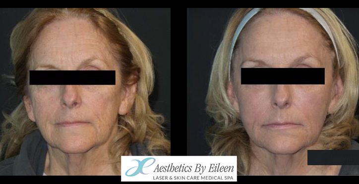 sculptra 3 sculptra 3