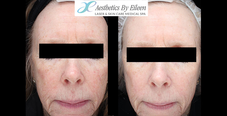 fraxel Judy front fraxel Judy front