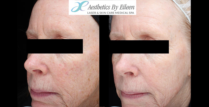 fraxel Judy side fraxel Judy side