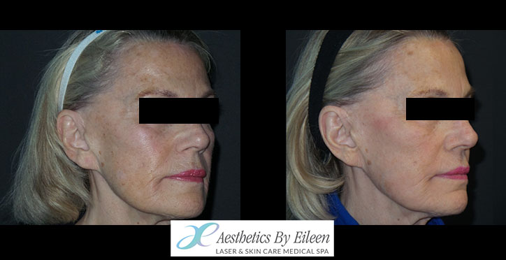 fraxel blonde side fraxel blonde side