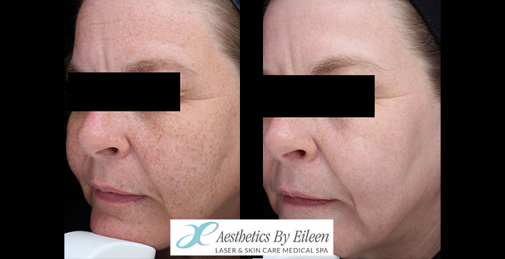 fraxel mary triplett side fraxel mary triplett side