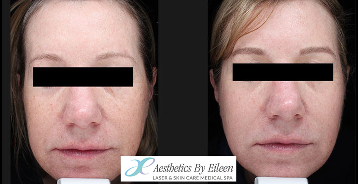 fraxel pam griffin front fraxel pam griffin front