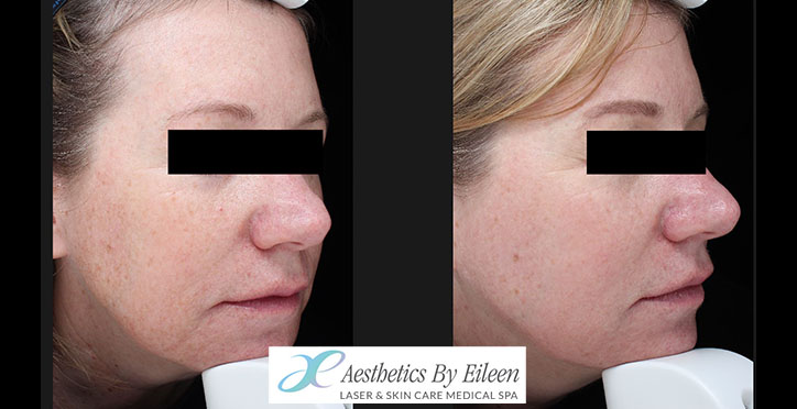 fraxel pam griffin side fraxel pam griffin side