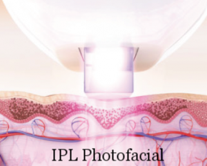 Venus+Versa+Photofacial+Spa+Rockaway