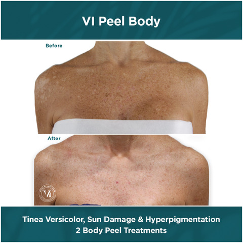 Tina Versicolor, Sun Damage Hyperpigmentation