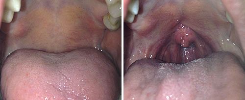 nightlase sippus3 nightlase sippus3