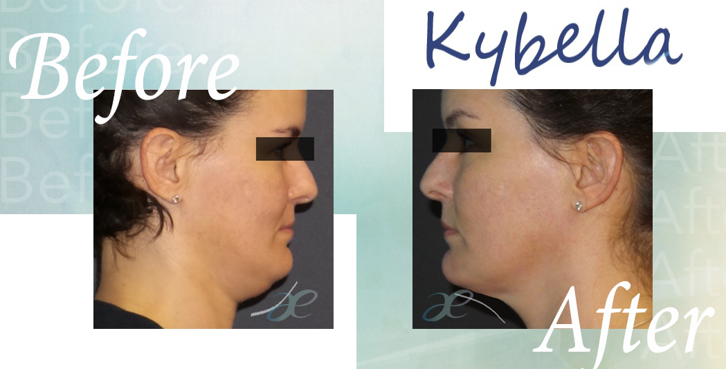 Kybella 1