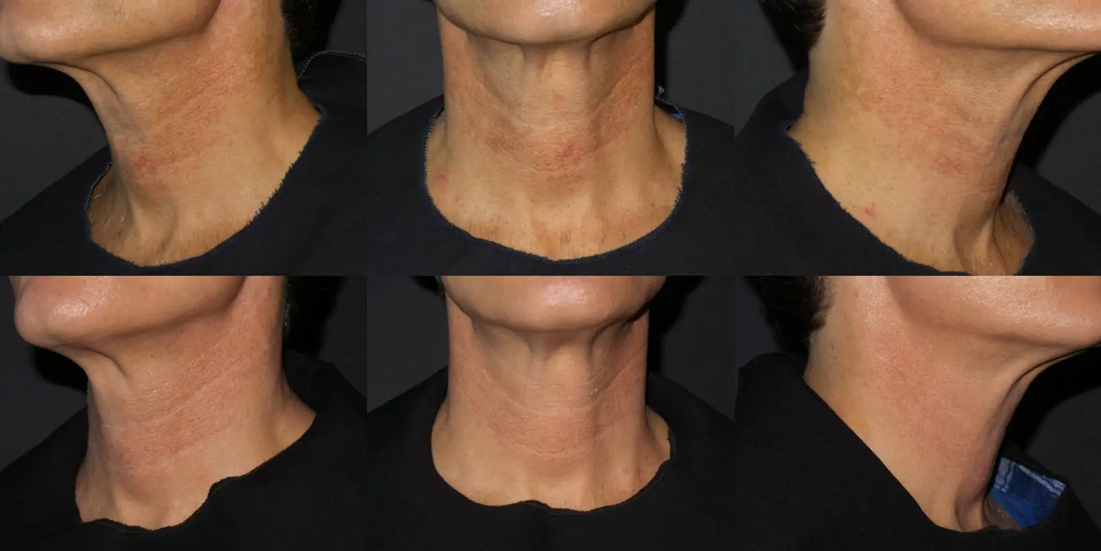 ipl raleigh before after