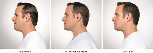 kybella men before after raleigh