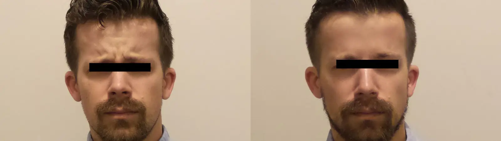 men botox raleigh before after