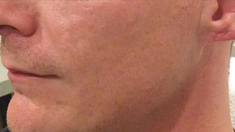 acne scars bellafill raleigh after