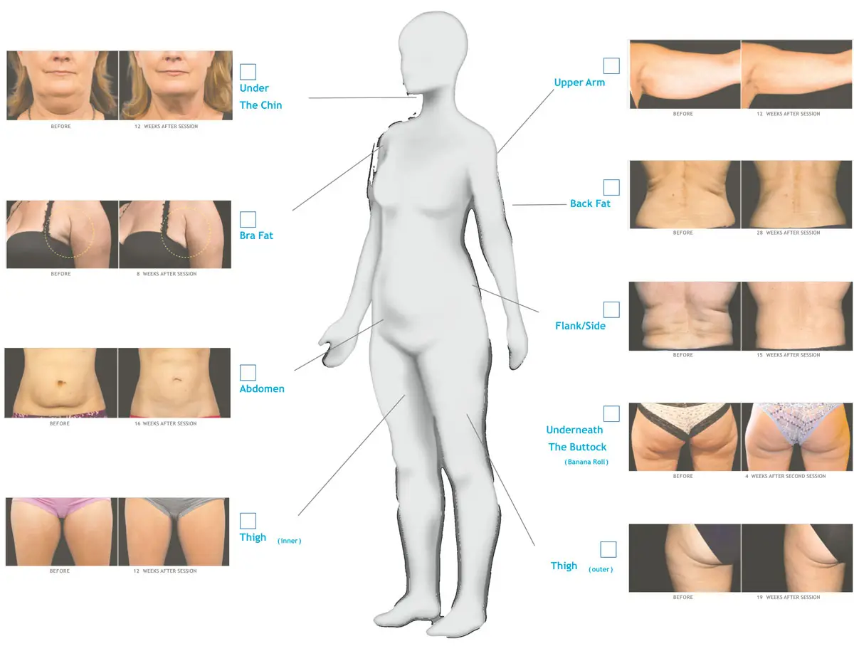 coolsculpting treatment map
