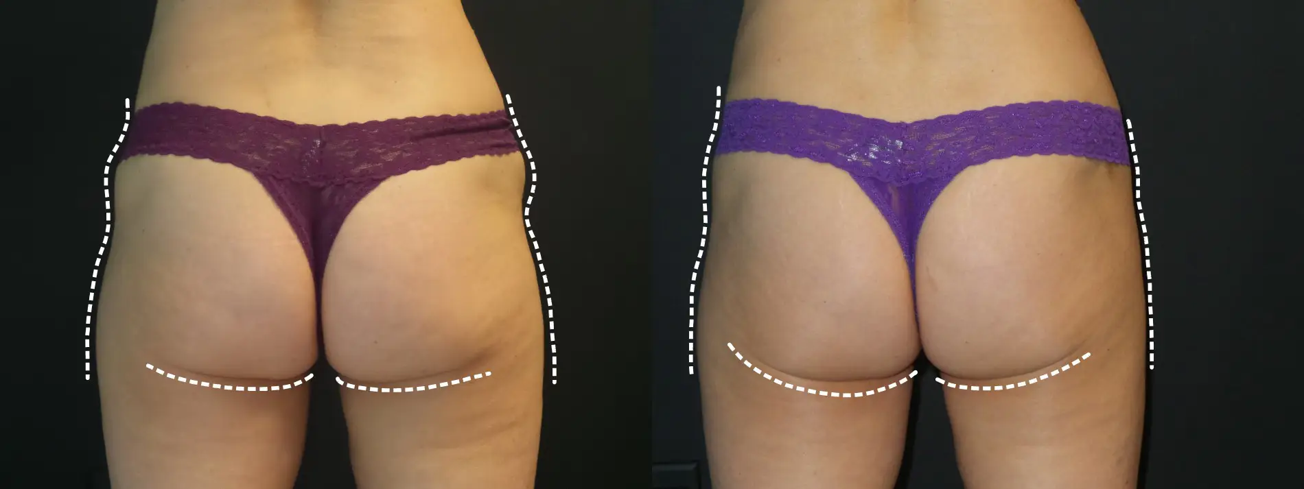 eileenemsculptbeforeandafter