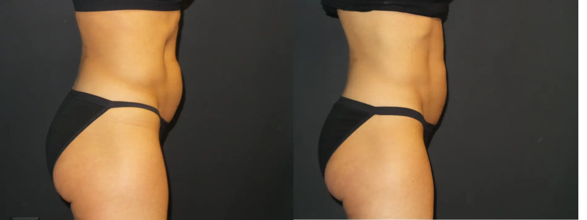 emsulptbeforeandafterabs