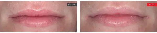 liplase courtesy of jolanda grayling liplase courtesy of jolanda grayling