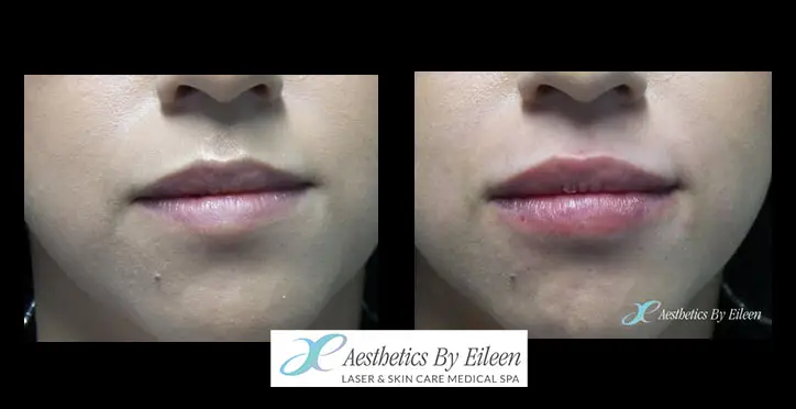 lips BA restylane lips BA restylane