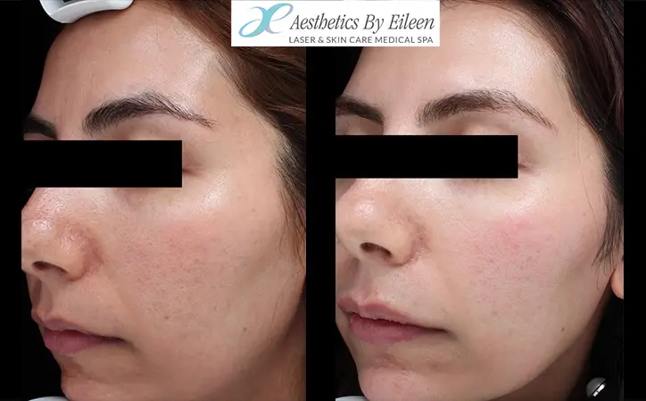 microneedling before after