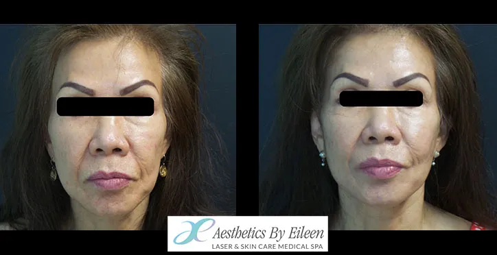 restylane portfolio restylane portfolio