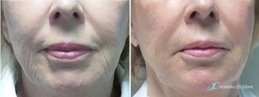 restylane silk restylane silk