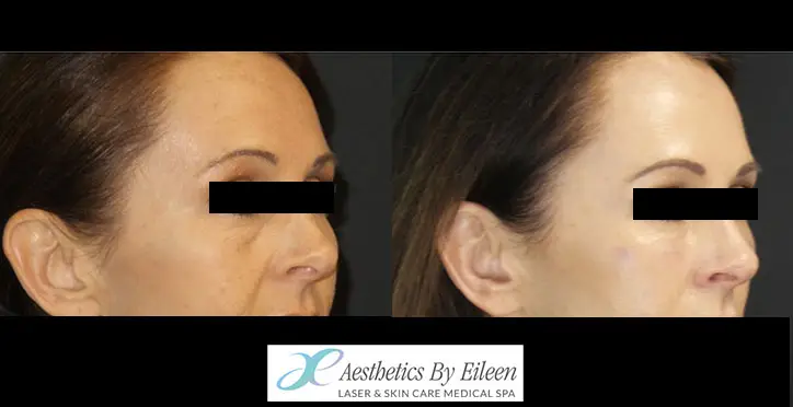 restylane undereye filler 2 restylane undereye filler 2
