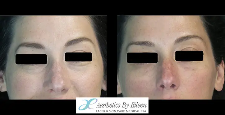 restylane undereye filler 3 restylane undereye filler 3