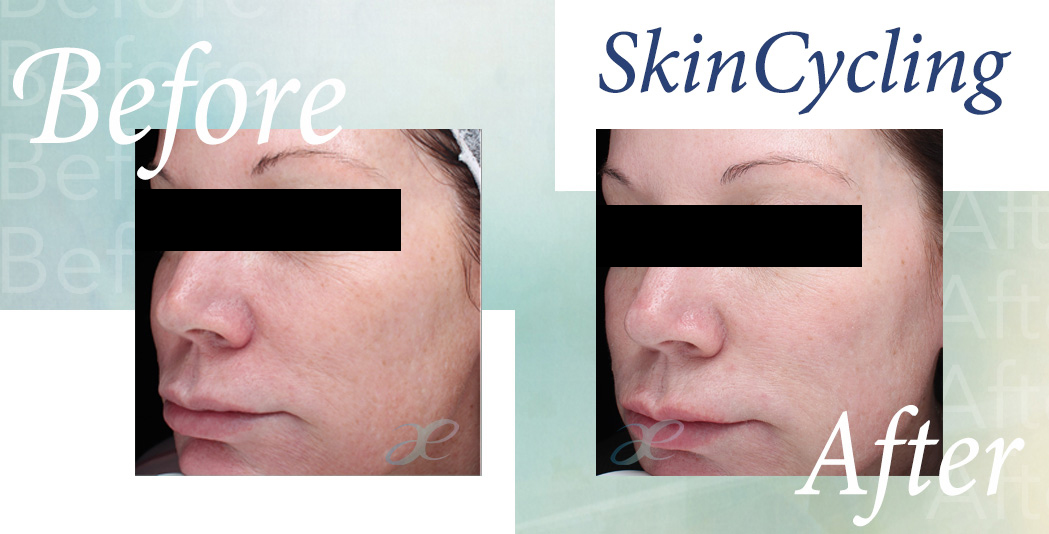 Skin cycling results