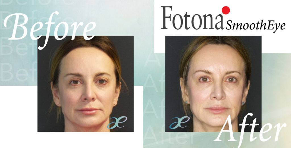 fotona-smootheye-aesthetics-by-eileen