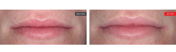 LipLase smooth lips results!