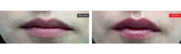 LipLase smooth lips results!
