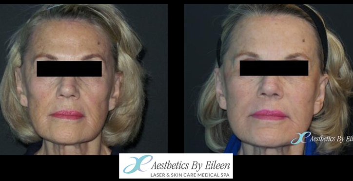 Sculptra and Fraxel results